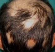Alopecia Areata Multifocal Asociada A Sepsis Bucodental Reporte De Un