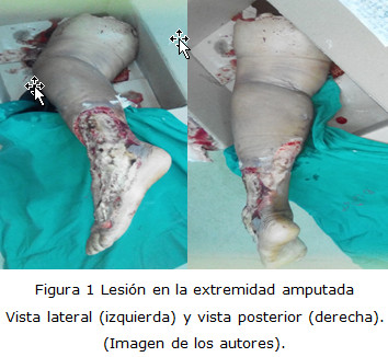 en paciente con herida infectada por mordedura canina | Piñón-García | Archivo Médico