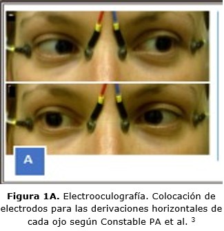 figura 1A