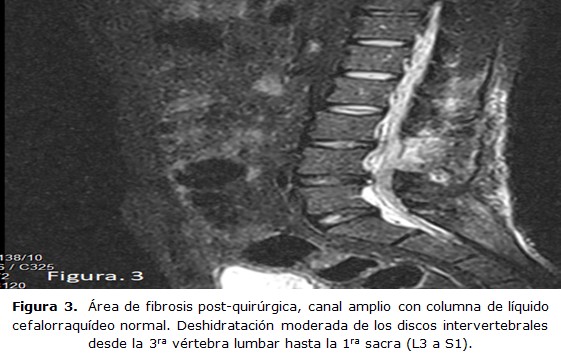 Evaluación de la columna lumbar posquirúrgica - ScienceDirect