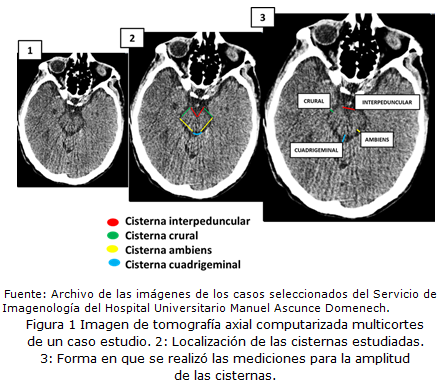 Anatomía De La Cisterna Supraselar