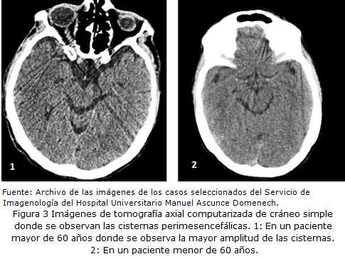 Anatomía De La Cisterna Supraselar