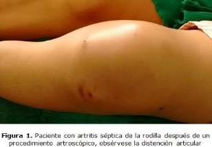 Artritis séptica de la rodilla, Álvarez López