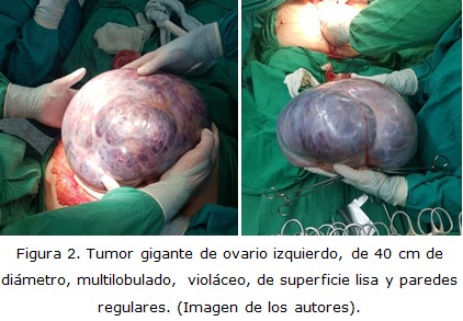 32- Ooforectomia- Remoção dos Ovários por Tumor (Adenoma Mucisono